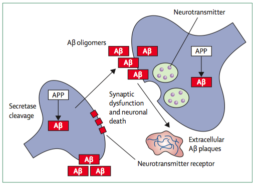 alzheimer alzheimer